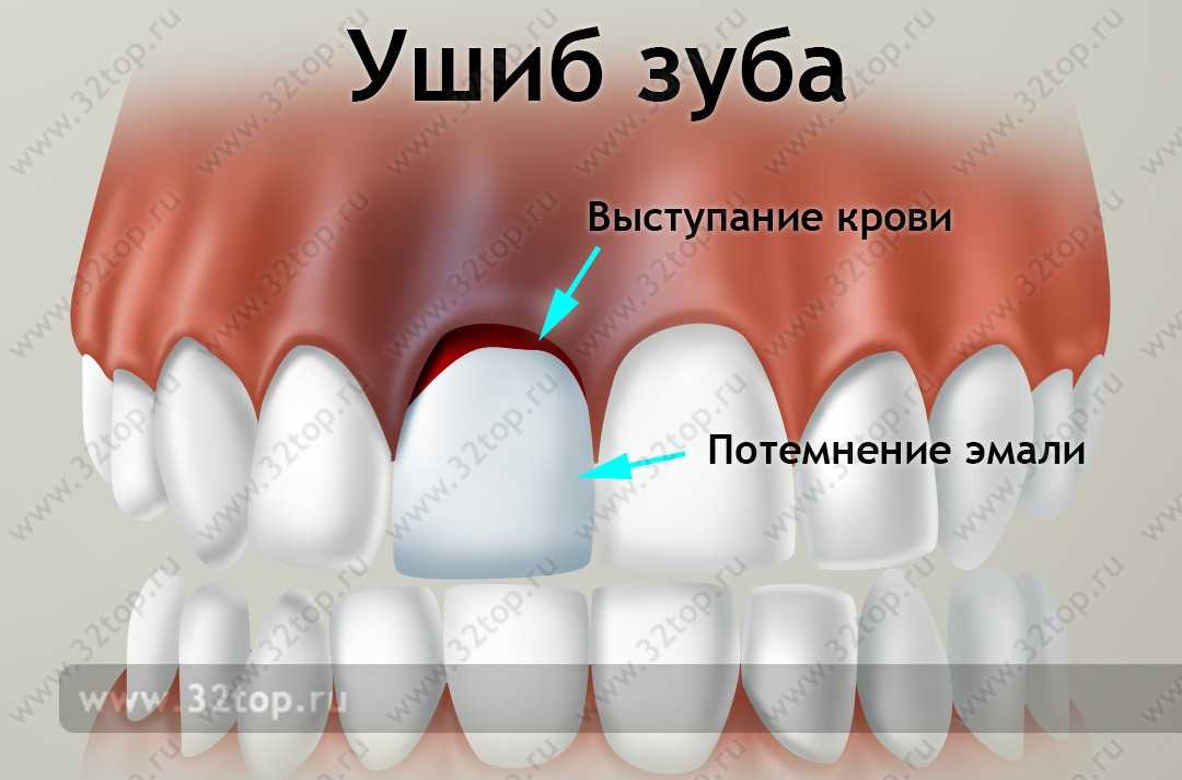 Ушиб зуба: причины, симптомы, последствия, лечение