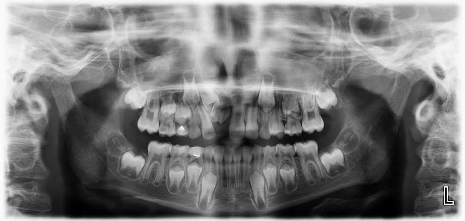 Рентгеновский снимок молочных зубов