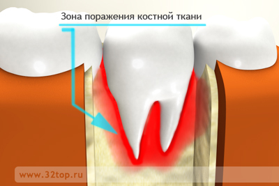 классификация остеомиелита челюстей