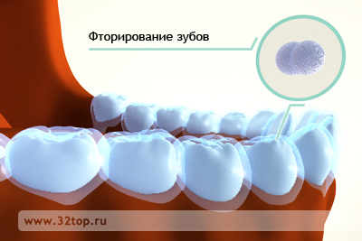 глубокое фторирование зубов