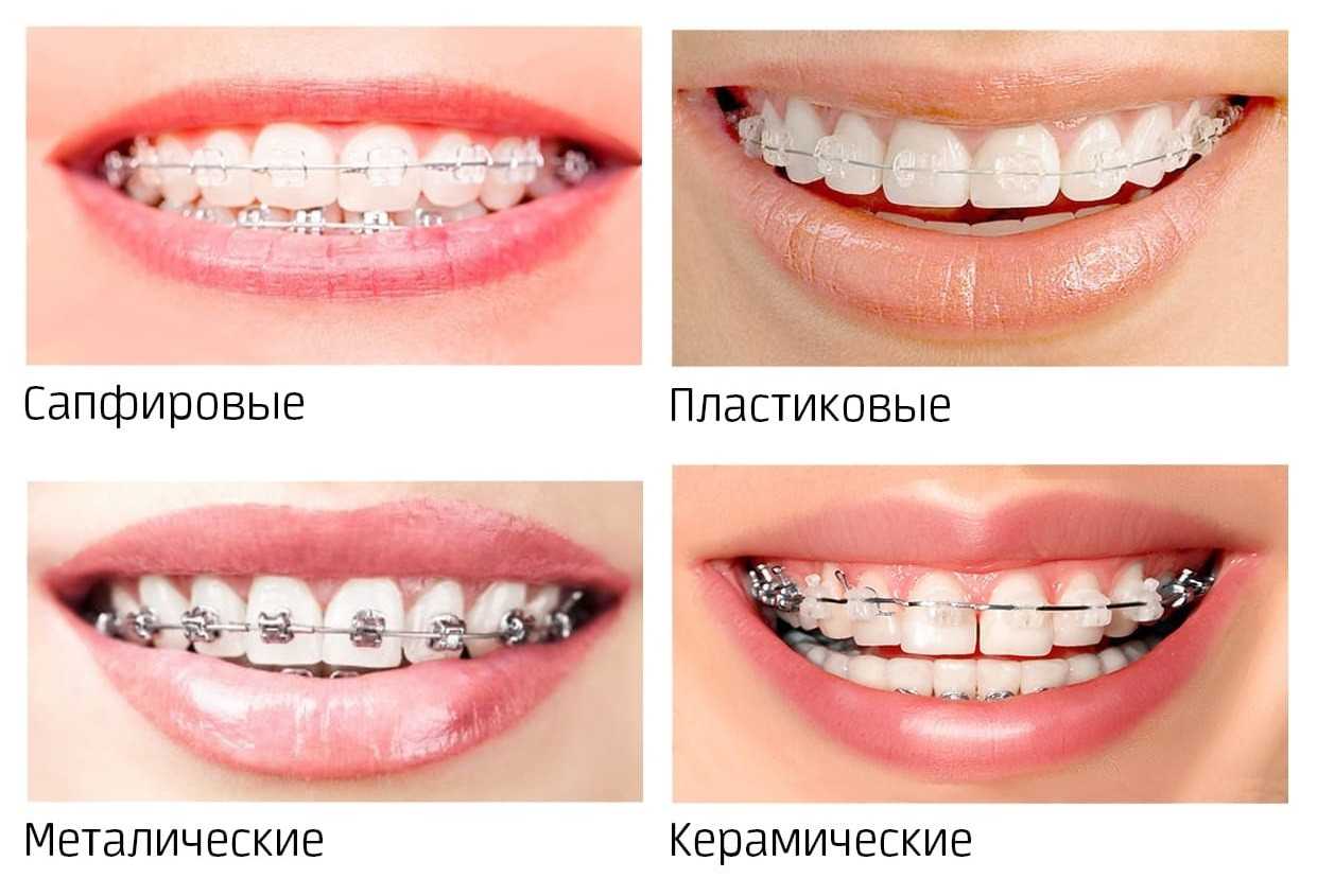 Пластиковые брекеты Томск Гагарина александра стоматология томск
