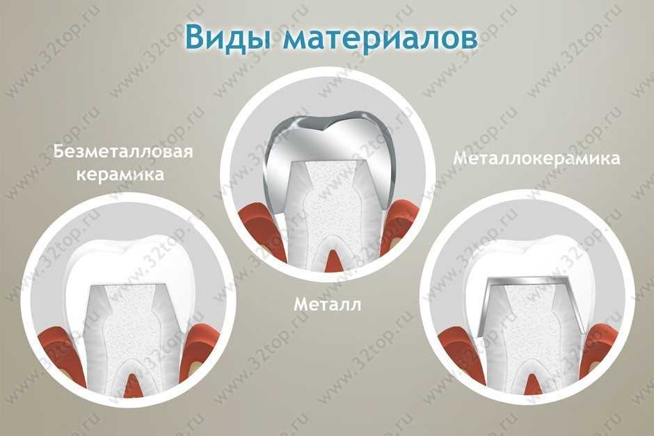 Виды коронок