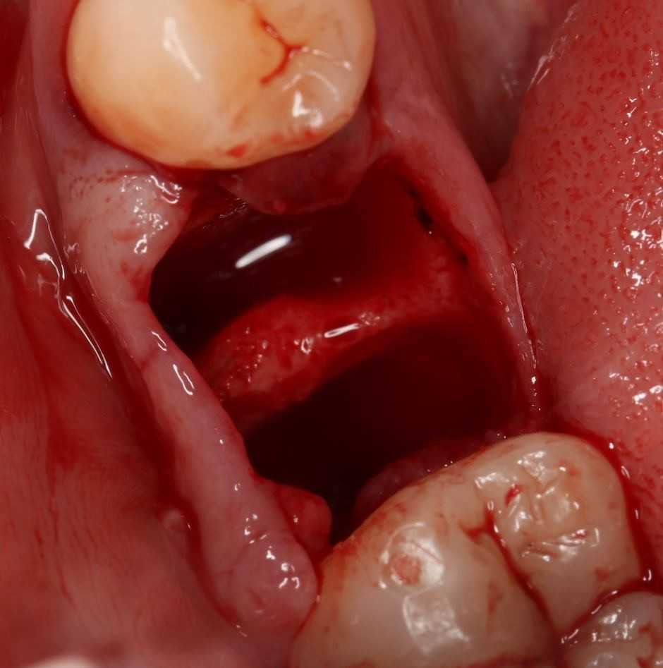 В норме после удаления зуба лунка должна наполняться кровью