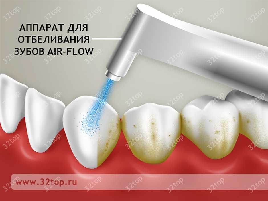 Лазерное отбеливание зубов Томск Профсоюзная стоматология томск отзывы мастер дент