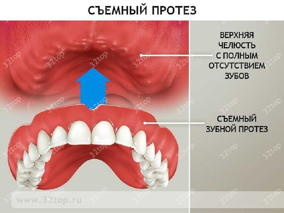 Съемный зубной протез