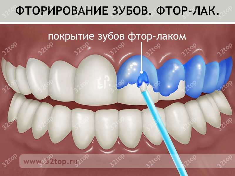Покрытие зуба защитным лаком Томск Калужский