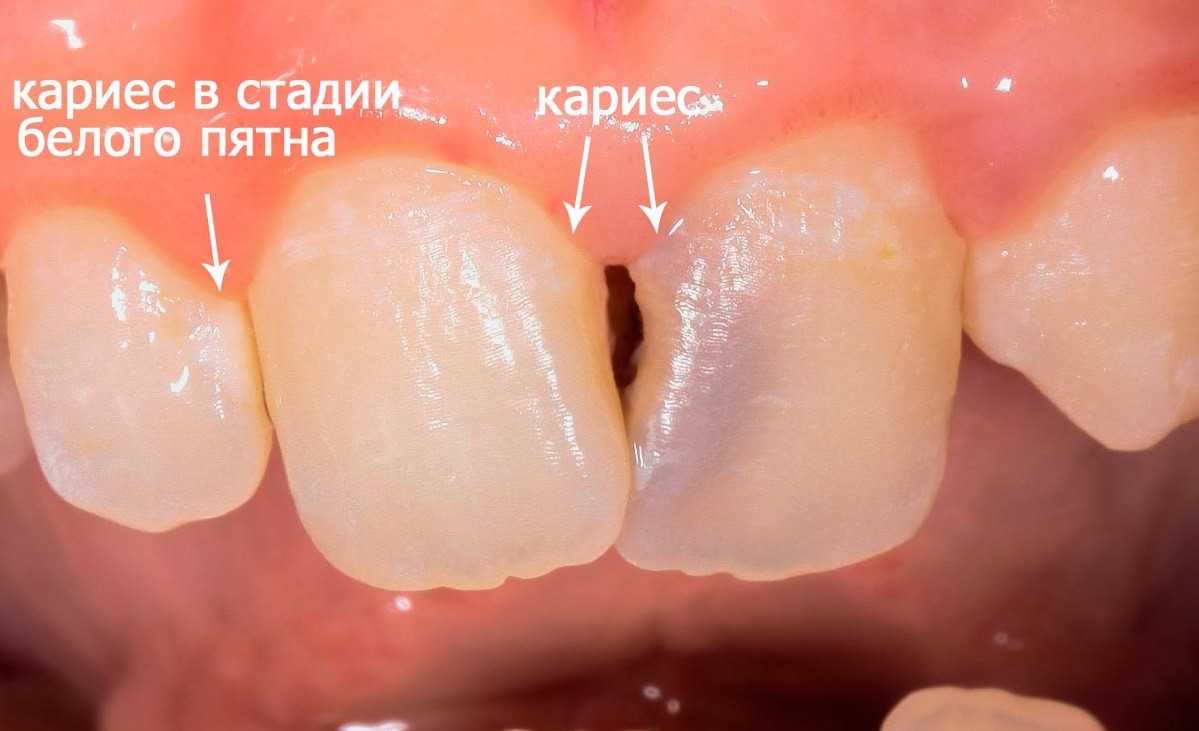 Покрытие зуба защитным лаком Томск Восточная Композитные виниры Томск Андрея Крячкова