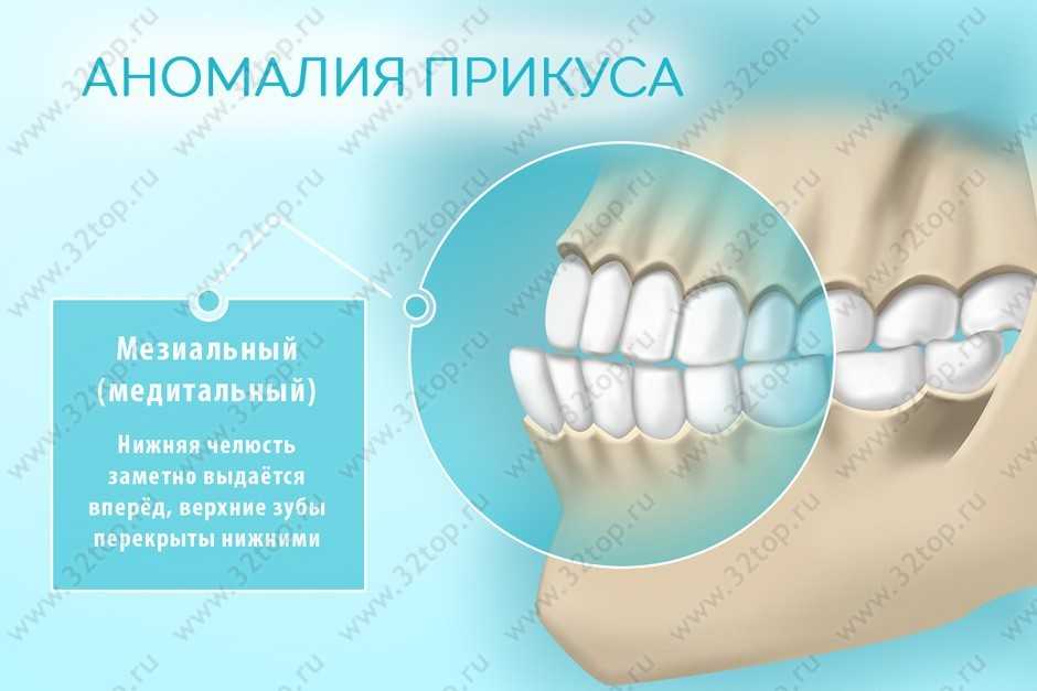 Перекрестный прикус презентация