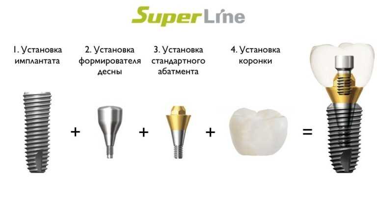 Импланты SuperLine Томск Иркутский лечение зубов детям во сне томск