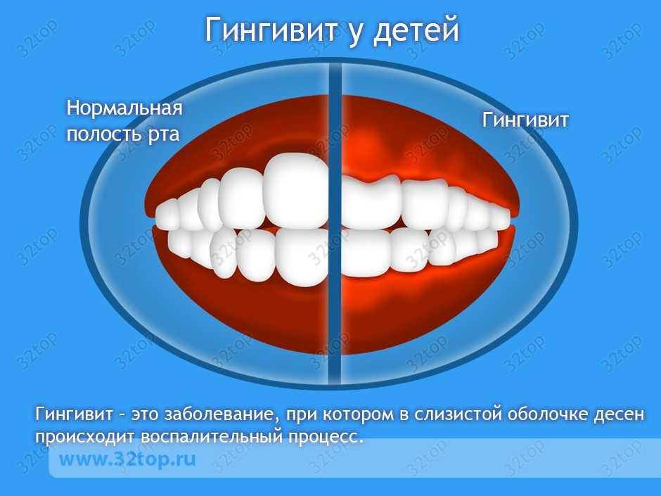 Gingivit U Detej Simptomy Lechenie Gingivita Lechenie Gingivita V Domashnih Usloviyah