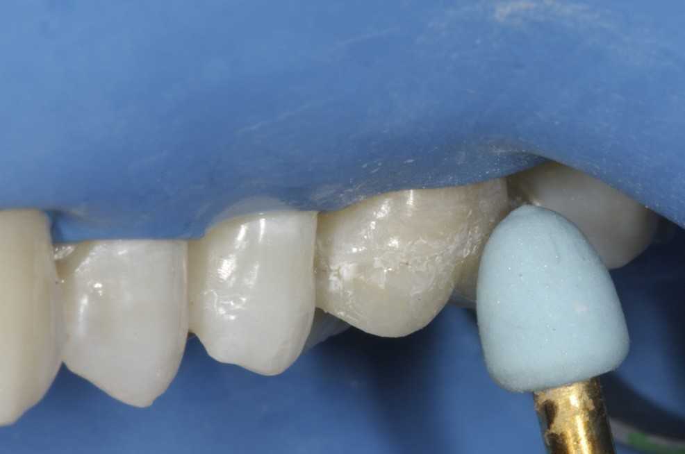 Полировка зуба