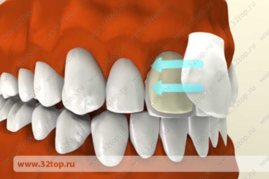 Непрямая реставрация зубов