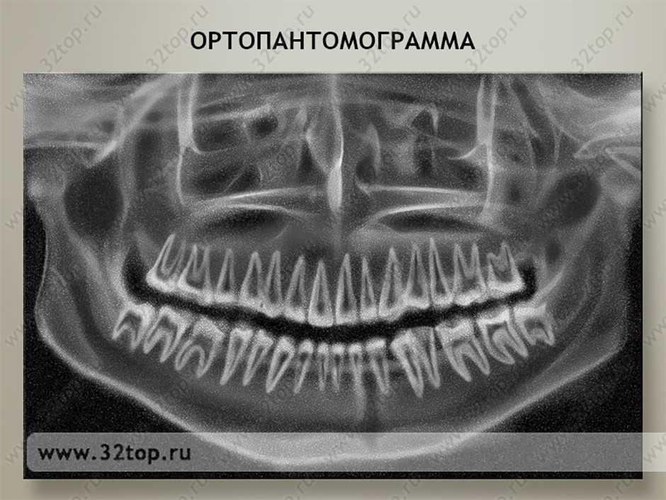 Панорамный снимок челюсти