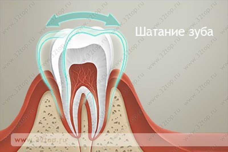 Шатается передний коренной зуб что делать. Патологическая подвижность зубов.