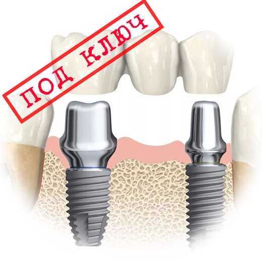 Имплантация Зубов Стоимость К31